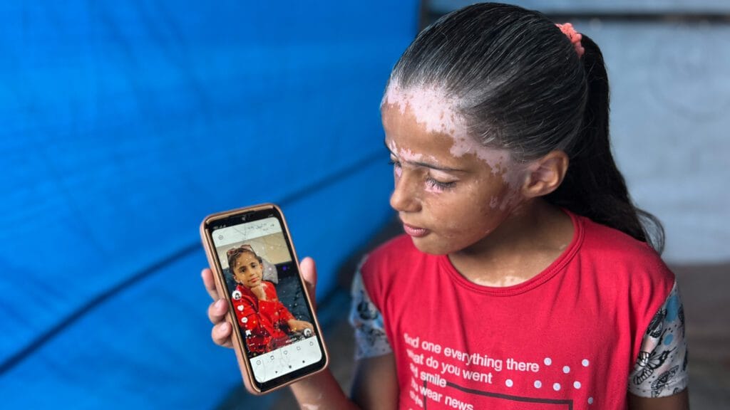 „Idős gyermek”: Az izraeli bombázás traumája megőszítette egy gázai kislány haját 5 IMG 8909 1