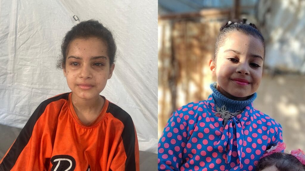 „Elvesztettem a családomat, az otthonomat, a látásomat”: Izrael ezreket vakított meg Gázában 5 rihan