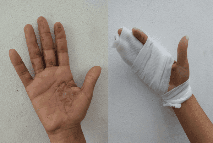 Eczema_Shaimaa_supplied